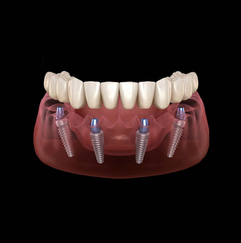 All On 4 Dental Implants Plano TX | Dental Implants | Plano Smile Studio