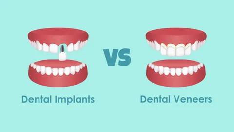 Combining Dental Implants and Veneers: A Professional Guide by Your Cosmetic Dentist in Plano