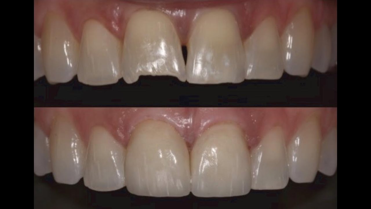 Getting a Second Opinion on Botched Veneers from a Cosmetic Dentist in Plano: Porcelain Veneers Repair and Correction