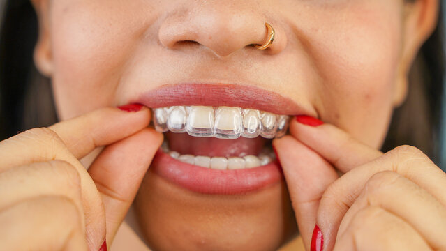 Fixing Uneven Edges After Invisalign with a Cosmetic Dentist in Plano: Effective Post-Orthodontic Dental Repair Solutions