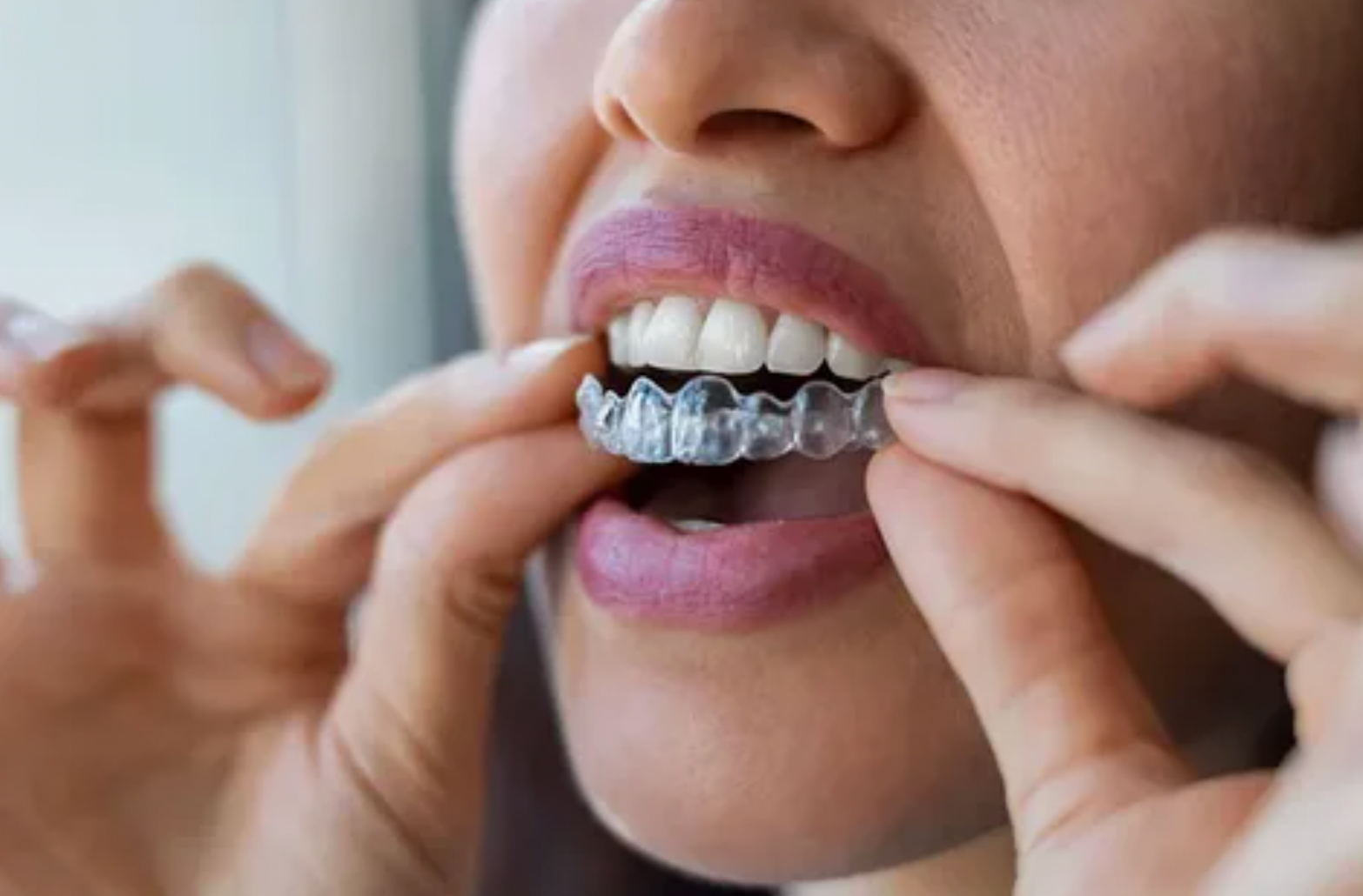 Life After Invisalign Plano: Why Your Retainer Is the Key to Keeping Your New Smile