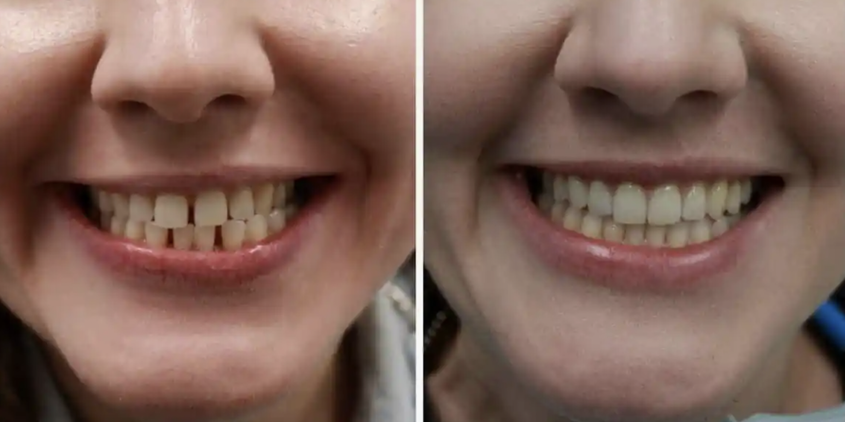 Real Before & After Invisalign Treatment Results in Plano TX at Plano Smile Studio