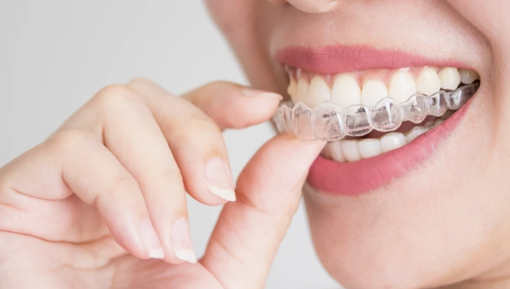 How Much Does Invisalign Cost in Plano TX and What Financing Options Are Available?